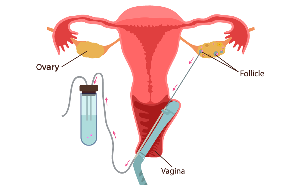 a diagram of egg retrieval for IVF treatment